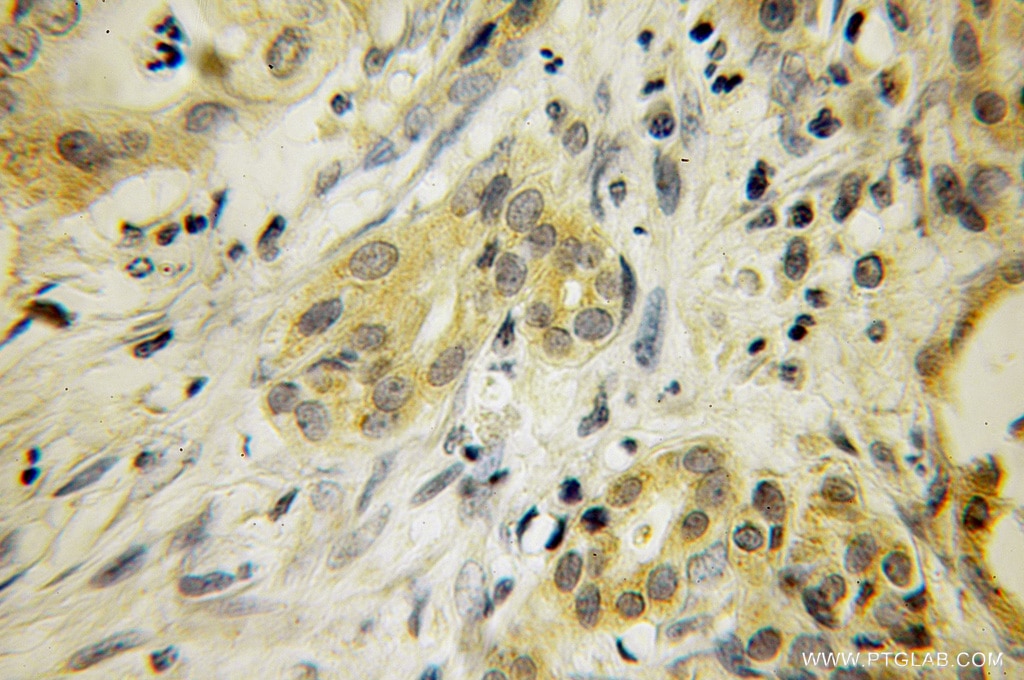 Immunohistochemistry of paraffin-embedded human pancreas cancer using 12767-1-AP(SAV1 Antibody) at Dilution 1:100 (under 10x lens) SAV1 IHC Immunohistochemical 12767-1-AP SAV1 Antibody SAV; WW45; WWP4