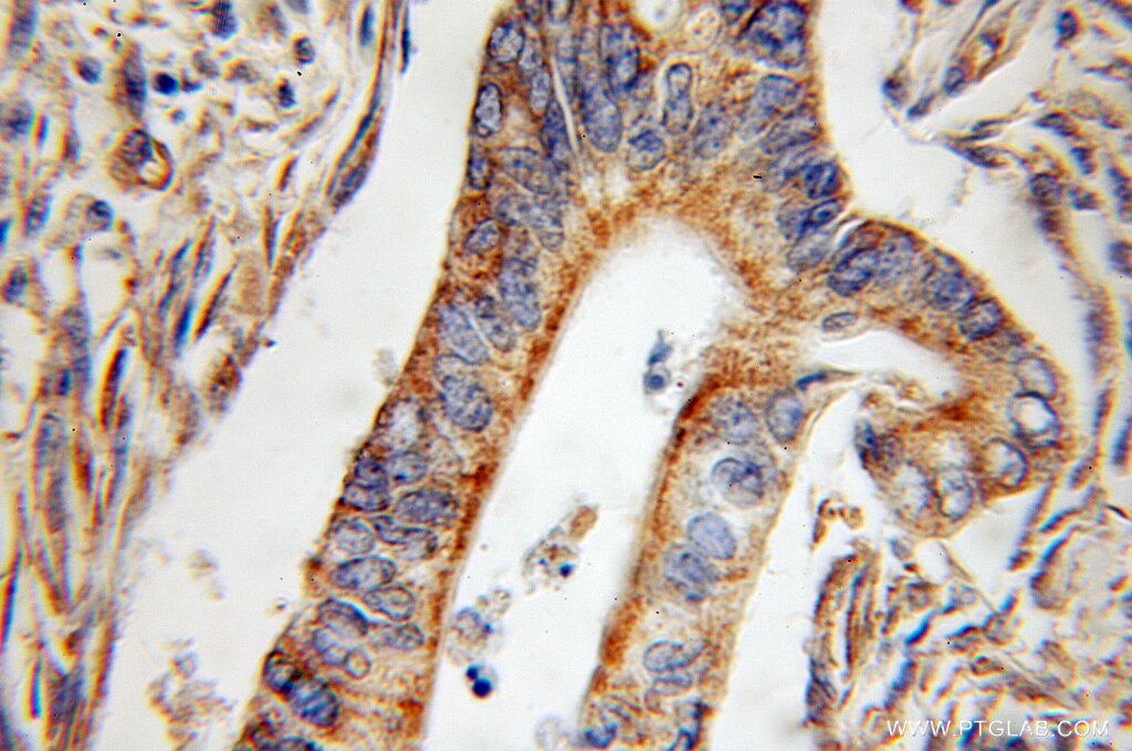Immunohistochemistry of paraffin-embedded human pancreas cancer using 11303-1-AP(SERPINE2 Antibody) at Dilution 1:50 (under 10x lens) SERPINE2 IHC Immunohistochemical 11303-1-AP SERPINE2 Antibody GDN; PI7; PN1; PNI