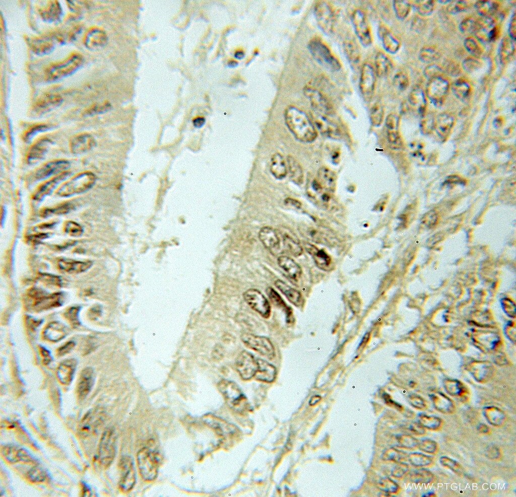 SF3B2 IHC Immunohistochemical 10919-1-AP SF3B2 Antibody SAP145; SF3B145; SF3b1; SF3b150