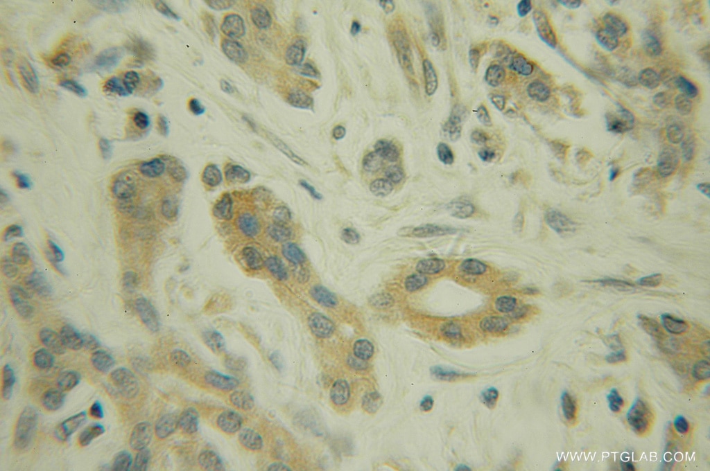Immunohistochemistry of paraffin-embedded human pancreas cancer using 12699-1-AP(SGK3 Antibody) at Dilution 1:100 (under 10x lens) SGK3 IHC Immunohistochemical 12699-1-AP SGK3 Antibody CISK; DKFZp781N0293; SGK2; SGKL
