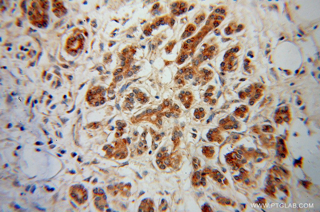 Immunohistochemistry of paraffin-embedded human pancreas cancer using 14184-1-AP(SGSH Antibody) at Dilution 1:50 (under 40x lens) SGSH IHC Immunohistochemical 14184-1-AP SGSH Antibody HSS; MPS3A; SFMD