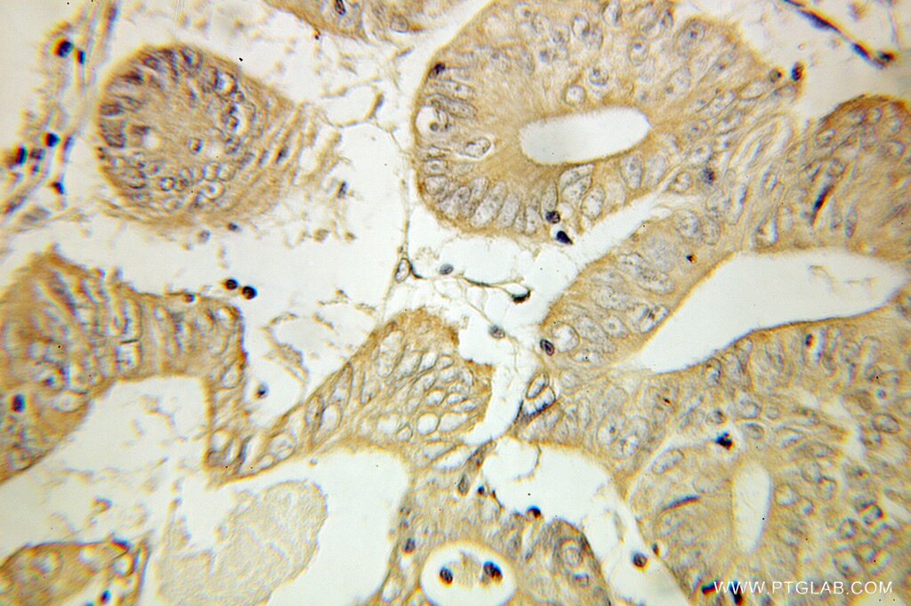 Immunohistochemistry of paraffin-embedded human colon cancer using 10789-1-AP(SLC25A13 Antibody) at Dilution 1:100 (under 10x lens) SLC25A13 IHC Immunohistochemical 10789-1-AP SLC25A13 Antibody ARALAR2; CITRIN; CTLN2