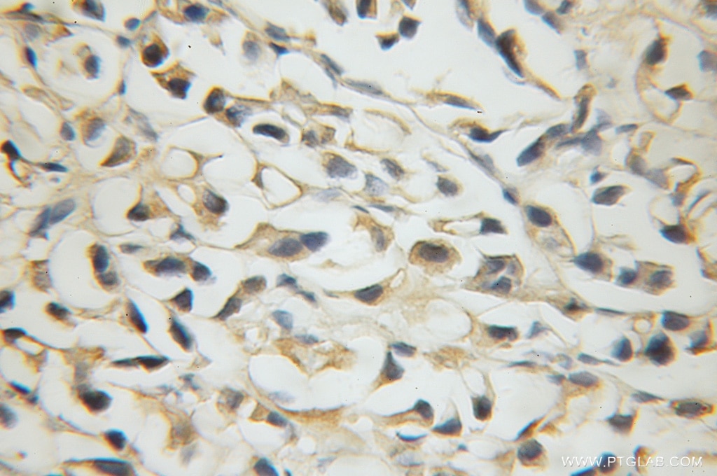 Immunohistochemistry of paraffin-embedded human prostate cancer using 12039-1-AP(SLC38A1 Antibody) at Dilution 1:50 (under 40x lens) SLC38A1 IHC Immunohistochemical 12039-1-AP SLC38A1 Antibody ATA1; NAT2; SAT1; SNAT1