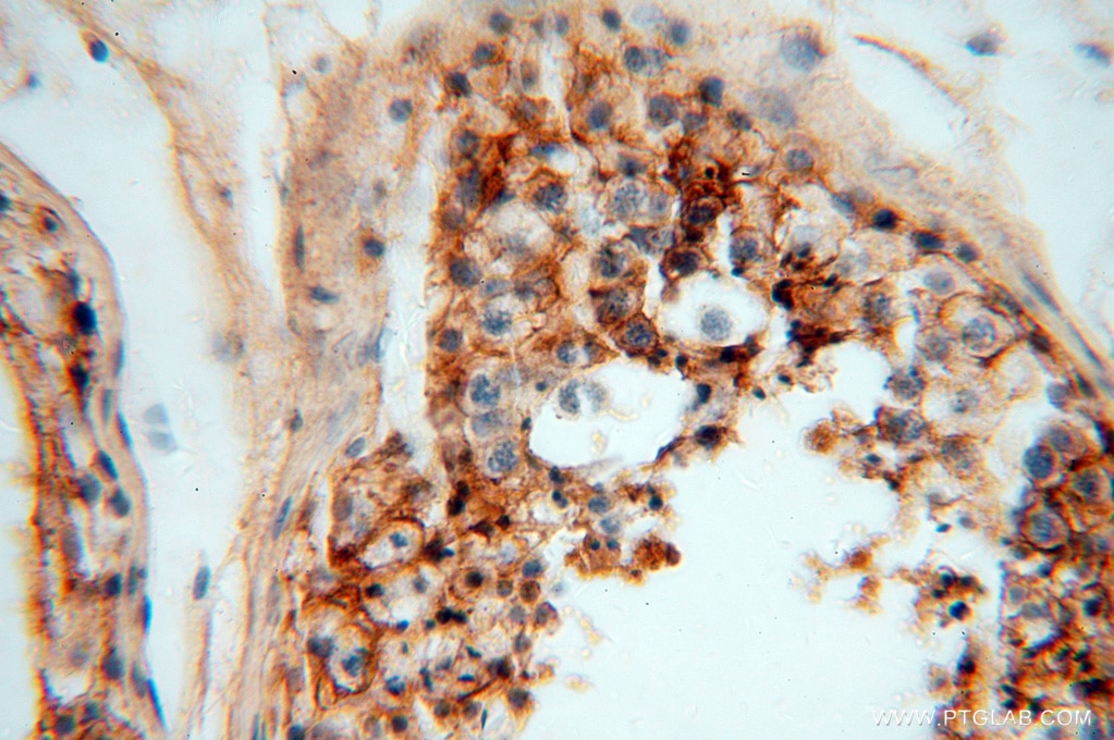 SLC3A2 IHC Immunohistochemical 15193-1-AP SLC3A2 Antibody 4F2; 4F2HC; 4T2HC; CD98; CD98HC; MDU1; NACAE