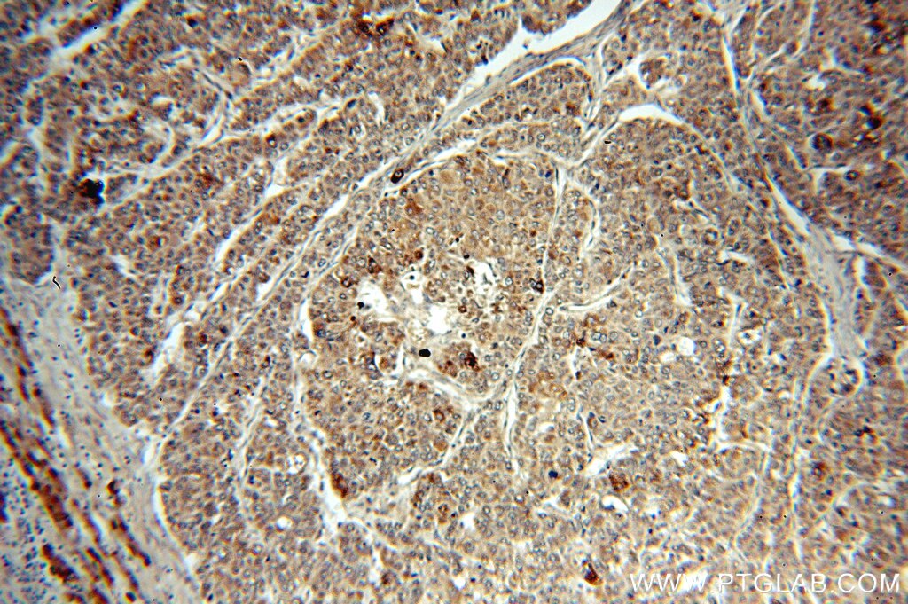 SMAD4 IHC Immunohistochemical 51069-2-AP SMAD4 Antibody DPC4; JIP; MADH4