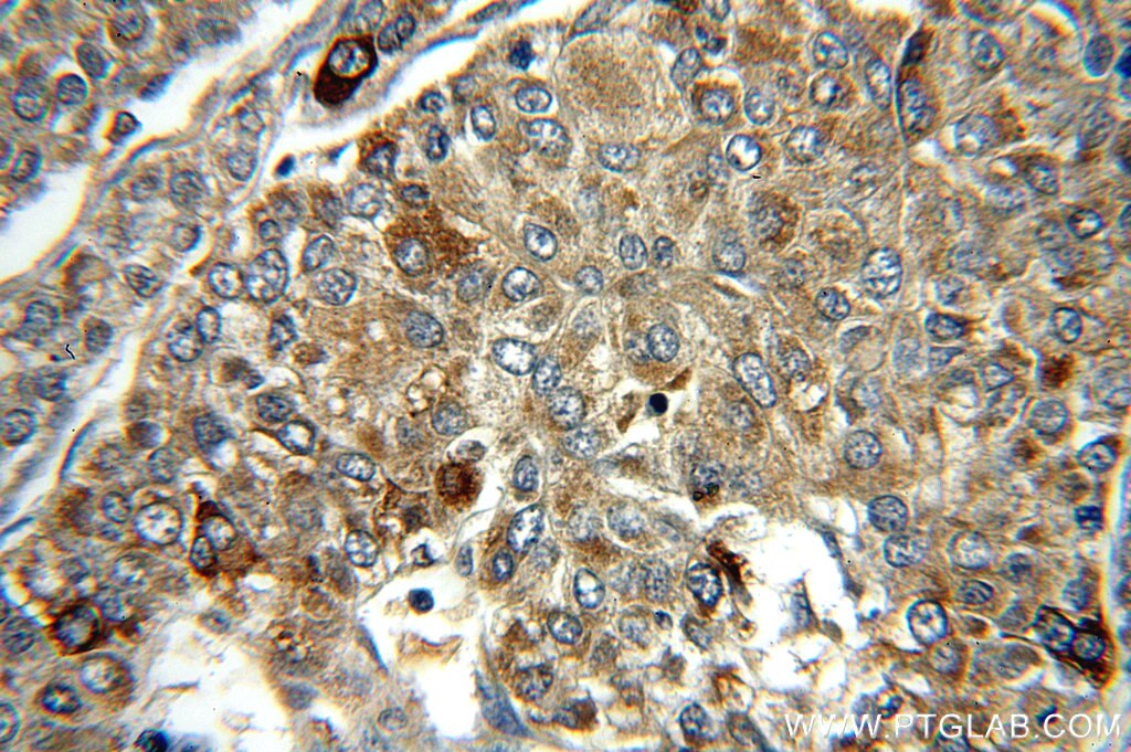 SMAD4 IHC Immunohistochemical 51069-2-AP SMAD4 Antibody DPC4; JIP; MADH4