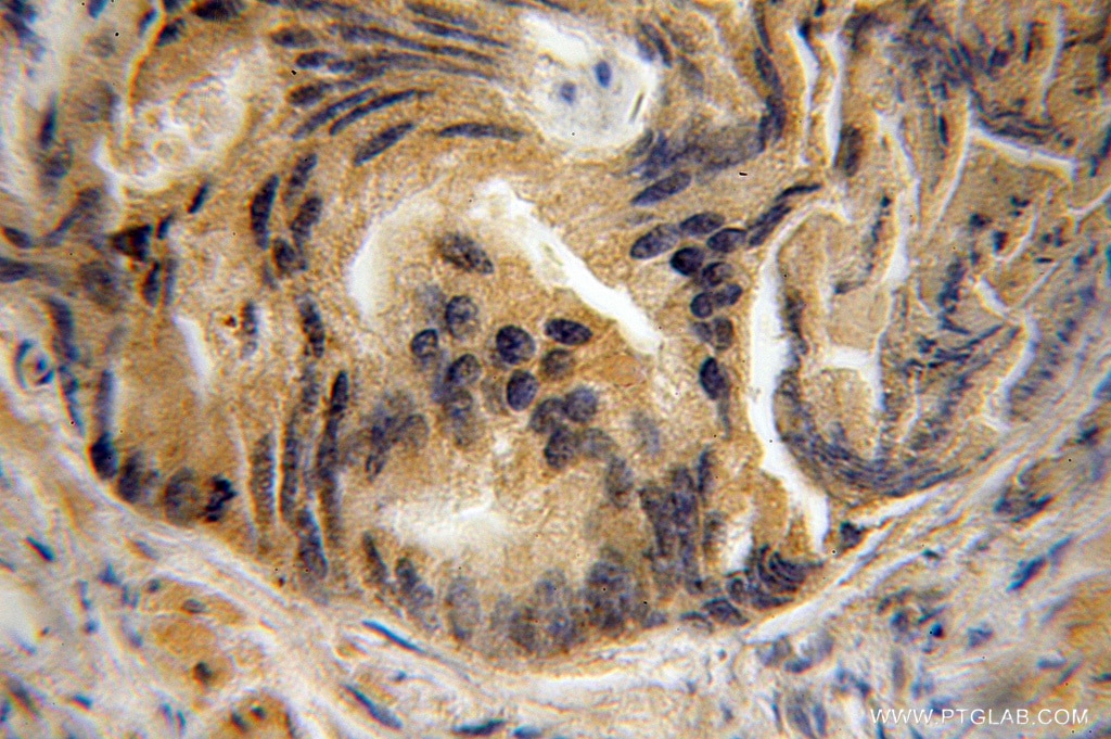 Immunohistochemistry of paraffin-embedded human prostate cancer using 11000-1-AP(SPATA2 Antibody) at Dilution 1:100 (under 10x lens) SPATA2 IHC Immunohistochemical 11000-1-AP SPATA2 Antibody FLJ13167; KIAA0757; PD1; tamo