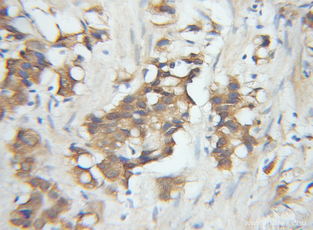 Immunohistochemistry of paraffin-embedded human prostate cancer using 11847-1-AP(SPCS1 Antibody) at Dilution 1:50 (under 10x lens) SPCS1 IHC Immunohistochemical 11847-1-AP SPCS1 Antibody HSPC033; SPC1; SPC12; YJR010C-A