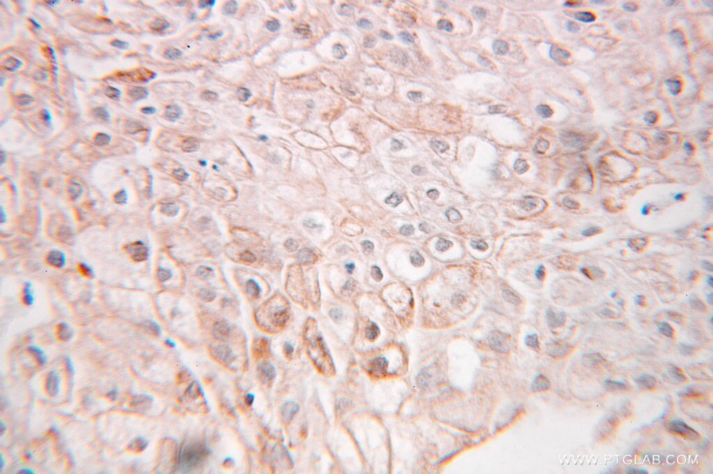 Immunohistochemistry of paraffin-embedded human ovary tumor using 10583-1-AP(TRAPA, SSR1 Antibody) at Dilution 1:100 (under 25x lens) TRAPA, SSR1 IHC Immunohistochemical 10583-1-AP TRAPA, SSR1 Antibody DKFZp781N23103; FLJ14232; FLJ22100; FLJ23034; FLJ78242; FLJ93042; TRAPA