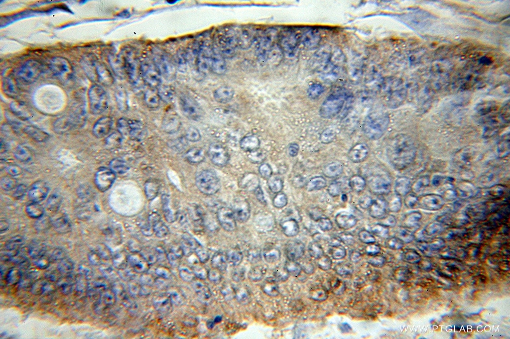Immunohistochemistry of paraffin-embedded human colon cancer using 11201-1-AP(STX16 Antibody) at Dilution 1:50 (under 10x lens) STX16 IHC Immunohistochemical 11201-1-AP STX16 Antibody MGC90328; SYN16; hsyn16