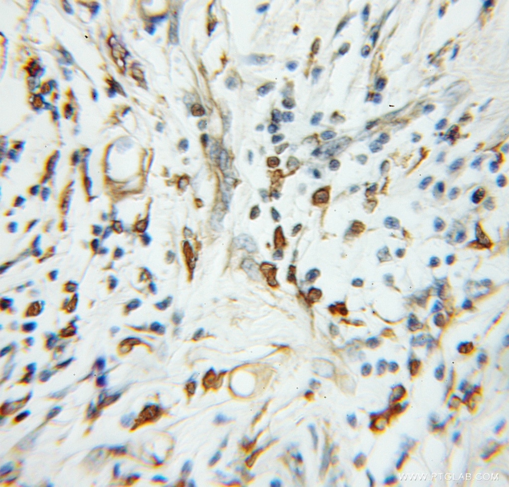 Immunohistochemistry of paraffin-embedded human colon cancer using 11299-1-AP(TADA2L Antibody) at Dilution 1:50 (under 10x lens) TADA2L IHC Immunohistochemical 11299-1-AP TADA2L Antibody ADA2; ADA2A; FLJ12705; KL04P; hADA2