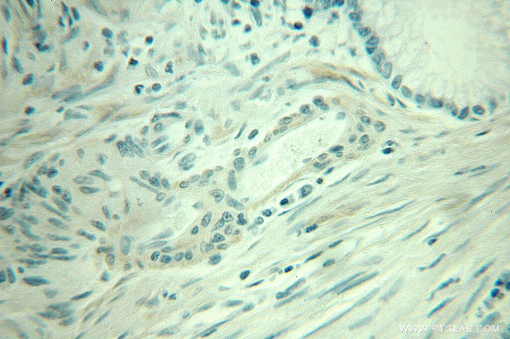 Immunohistochemistry of paraffin-embedded human colon cancer using 10493-1-AP(TAGLN Antibody) at Dilution 1:50 (under 10x lens) TAGLN IHC Immunohistochemical 10493-1-AP TAGLN Antibody DKFZp686P11128; SM22; SMCC; TAGLN1; WS3-10