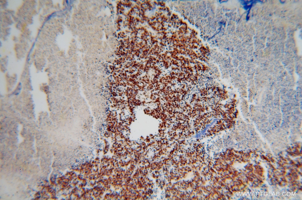 Immunohistochemistry of paraffin-embedded human lung cancer using TARDBP Antibody 12892-1-AP (under 10x lens) TARDBP IHC Immunohistochemistry 12892-1-AP TARDBP Antibody ALS10; TDP-43; Tdp43