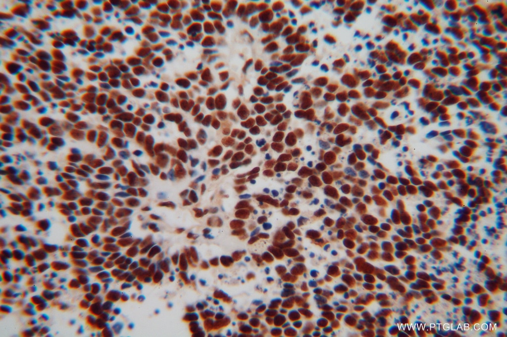 Immunohistochemistry of paraffin-embedded human lung cancer using TARDBP Antibody 12892-1-AP (under 40x lens) TARDBP IHC Immunohistochemistry 12892-1-AP TARDBP Antibody ALS10; TDP-43; Tdp43