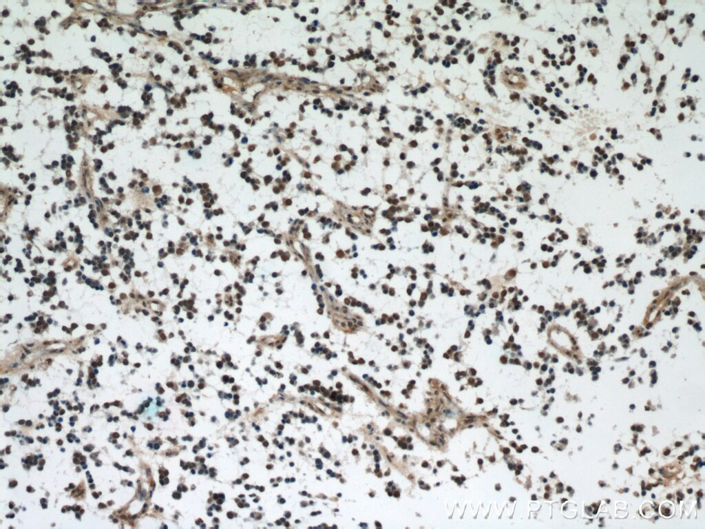 Immunohistochemistry of paraffin-embedded human gliomas using TARDBP Antibody 12892-1-AP (under 10x lens) TARDBP IHC Immunohistochemistry 12892-1-AP TARDBP Antibody ALS10; TDP-43; Tdp43