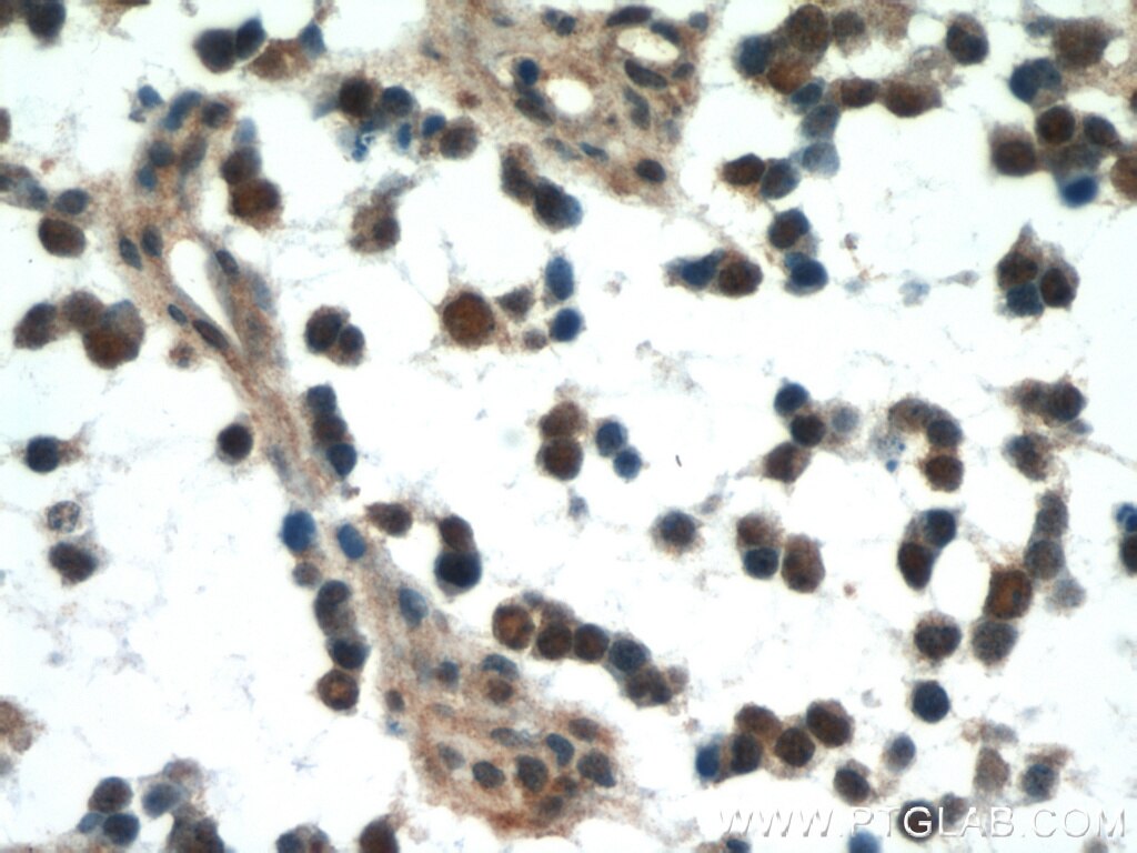 Immunohistochemistry of paraffin-embedded human gliomas using TARDBP Antibody 12892-1-AP (under 40x lens) TARDBP IHC Immunohistochemistry 12892-1-AP TARDBP Antibody ALS10; TDP-43; Tdp43