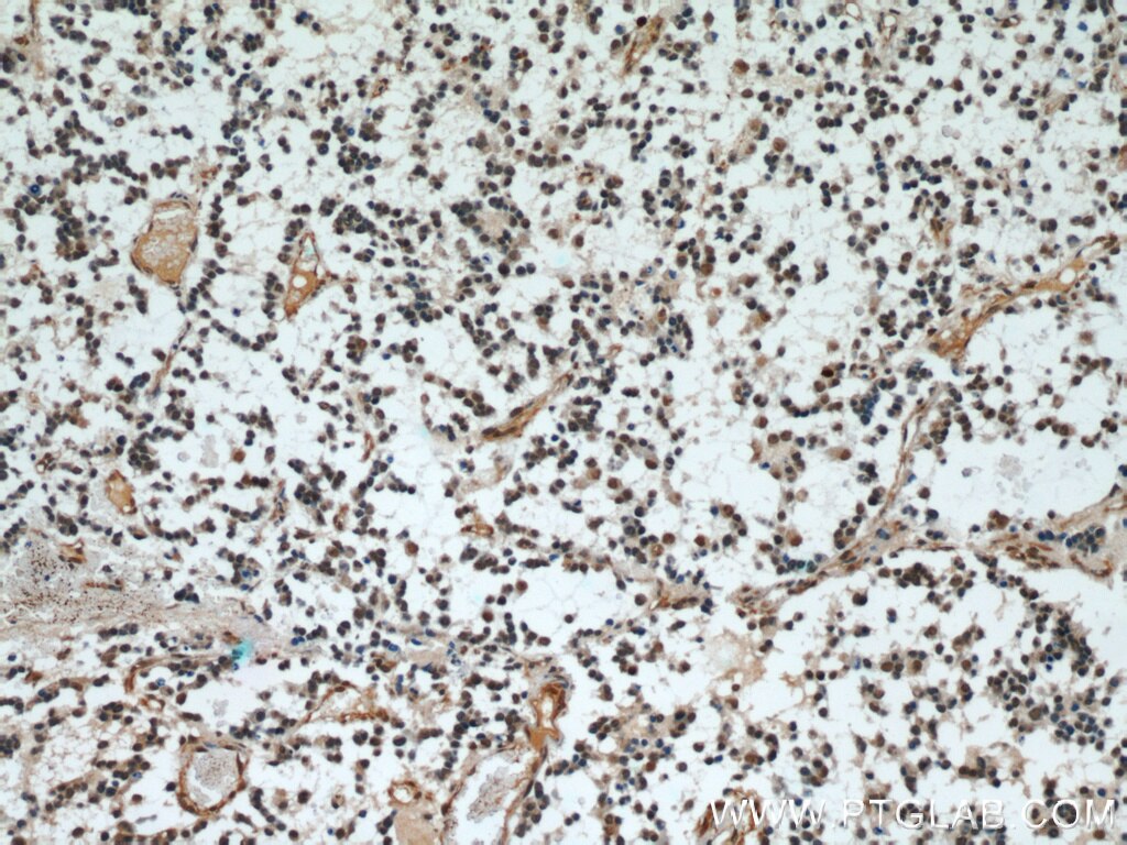 Immunohistochemistry of paraffin-embedded human gliomas using TARDBP Antibody 12892-1-AP (under 10x lens) TARDBP IHC Immunohistochemistry 12892-1-AP TARDBP Antibody ALS10; TDP-43; Tdp43
