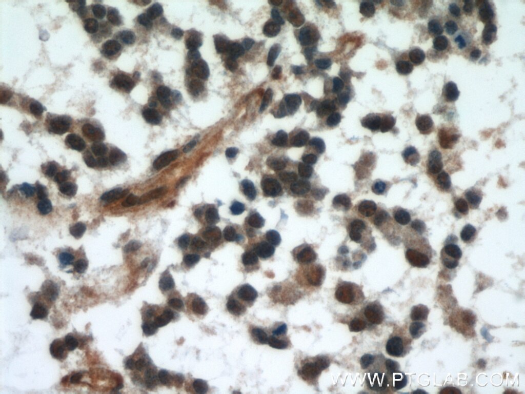 Immunohistochemistry of paraffin-embedded human gliomas using TARDBP Antibody 12892-1-AP (under 40x lens) TARDBP IHC Immunohistochemistry 12892-1-AP TARDBP Antibody ALS10; TDP-43; Tdp43