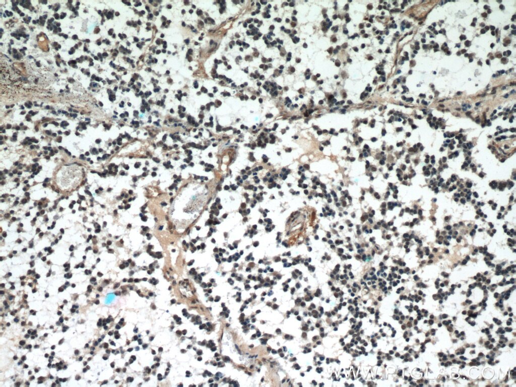 Immunohistochemistry of paraffin-embedded human gliomas using TARDBP Antibody 12892-1-AP (under 10x lens) TARDBP IHC Immunohistochemistry 12892-1-AP TARDBP Antibody ALS10; TDP-43; Tdp43