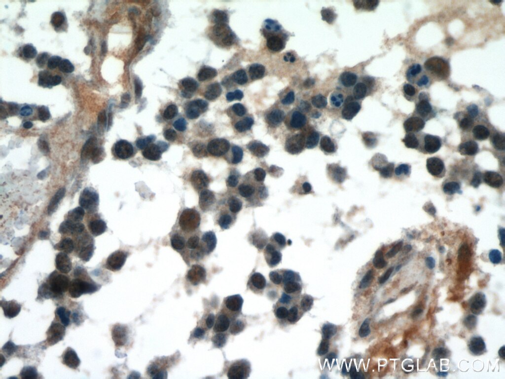 Immunohistochemistry of paraffin-embedded human gliomas using TARDBP Antibody 12892-1-AP (under 40x lens) TARDBP IHC Immunohistochemistry 12892-1-AP TARDBP Antibody ALS10; TDP-43; Tdp43