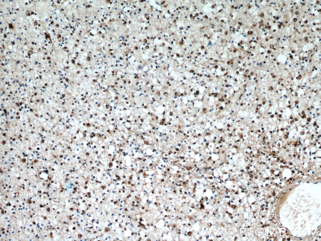 Immunohistochemistry of paraffin-embedded human gliomas using TARDBP Antibody 12892-1-AP (under 10x lens) TARDBP IHC Immunohistochemistry 12892-1-AP TARDBP Antibody ALS10; TDP-43; Tdp43