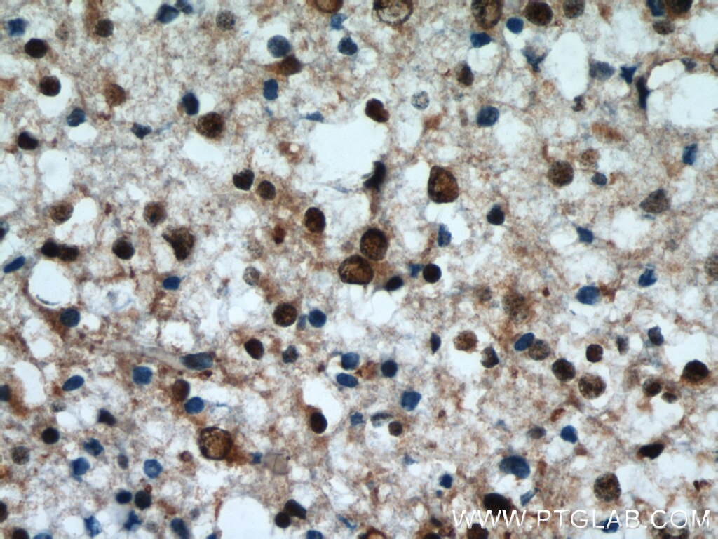 Immunohistochemistry of paraffin-embedded human gliomas using TARDBP Antibody 12892-1-AP (under 40x lens) TARDBP IHC Immunohistochemistry 12892-1-AP TARDBP Antibody ALS10; TDP-43; Tdp43