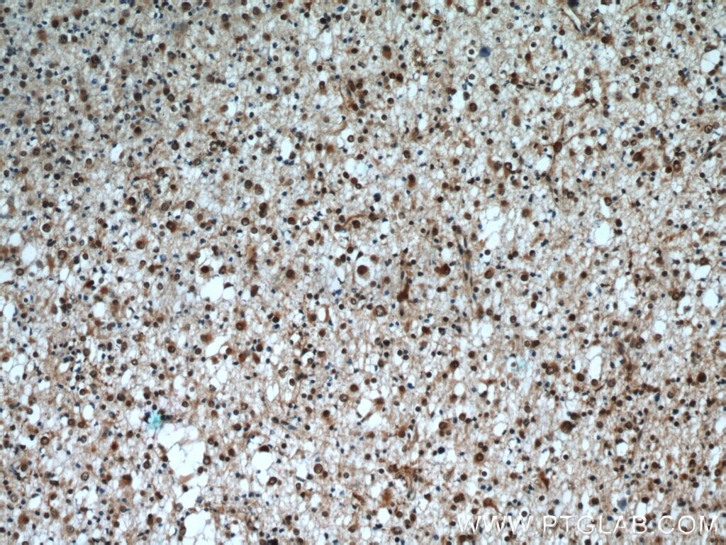 Immunohistochemistry of paraffin-embedded human gliomas using TARDBP Antibody 12892-1-AP (under 10x lens) TARDBP IHC Immunohistochemistry 12892-1-AP TARDBP Antibody ALS10; TDP-43; Tdp43