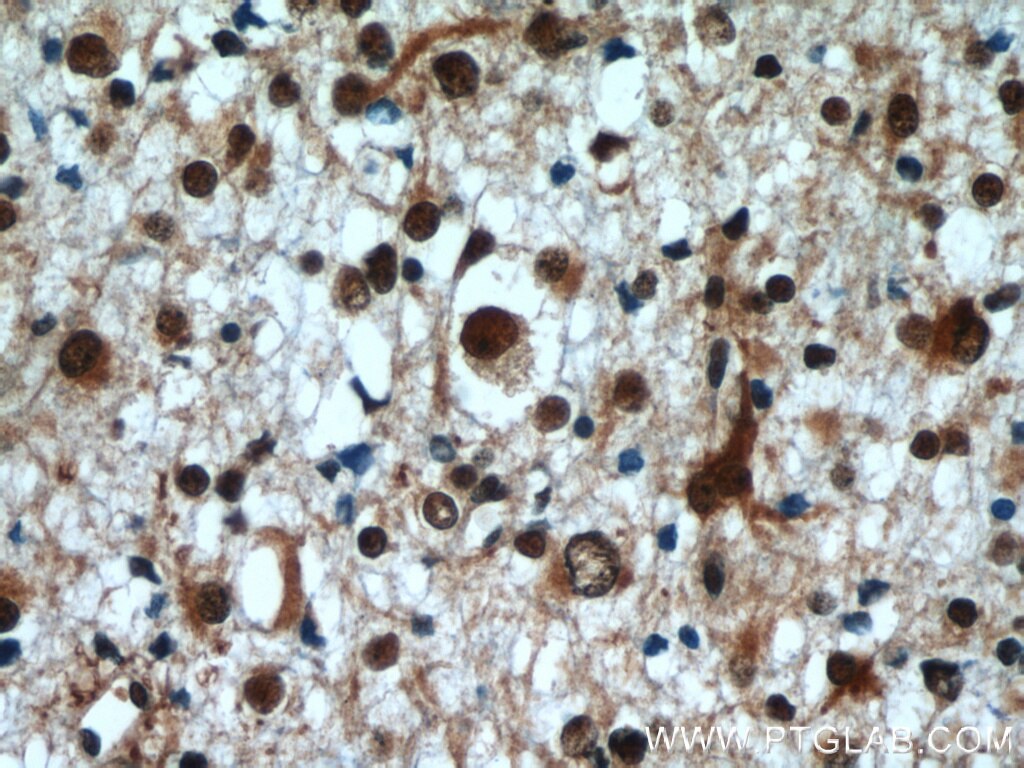 Immunohistochemistry of paraffin-embedded human gliomas using TARDBP Antibody 12892-1-AP (under 40x lens) TARDBP IHC Immunohistochemistry 12892-1-AP TARDBP Antibody ALS10; TDP-43; Tdp43