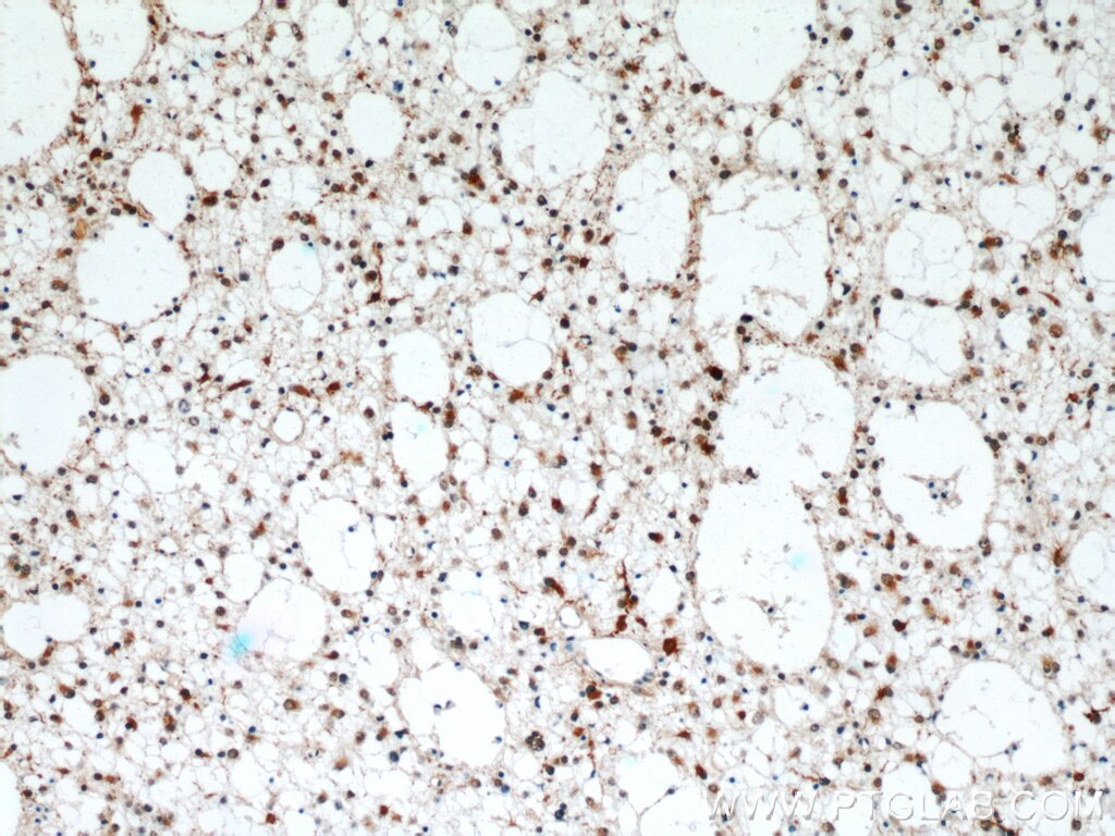 Immunohistochemistry of paraffin-embedded human gliomas using TARDBP Antibody 12892-1-AP (under 10x lens) TARDBP IHC Immunohistochemistry 12892-1-AP TARDBP Antibody ALS10; TDP-43; Tdp43
