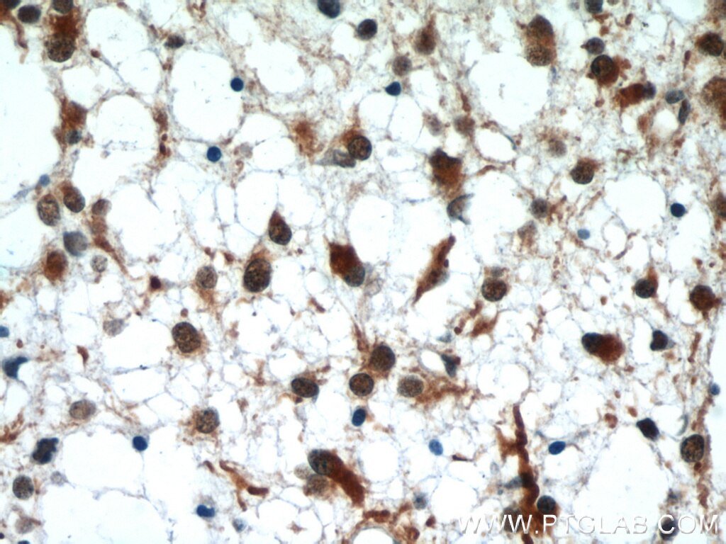 Immunohistochemistry of paraffin-embedded human gliomas using TARDBP Antibody 12892-1-AP (under 40x lens) TARDBP IHC Immunohistochemistry 12892-1-AP TARDBP Antibody ALS10; TDP-43; Tdp43