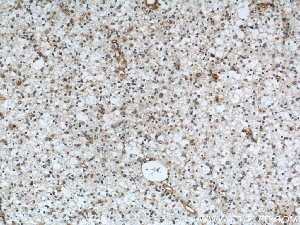 Immunohistochemistry of paraffin-embedded human gliomas using TARDBP Antibody 12892-1-AP (under 10x lens) TARDBP IHC Immunohistochemistry 12892-1-AP TARDBP Antibody ALS10; TDP-43; Tdp43