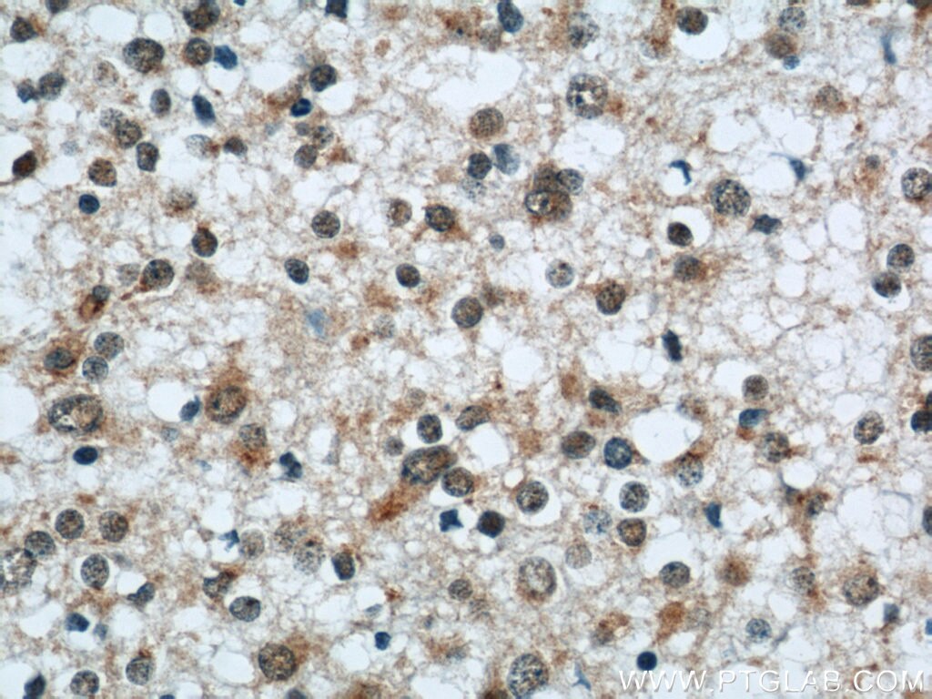 Immunohistochemistry of paraffin-embedded human gliomas using TARDBP Antibody 12892-1-AP (under 40x lens) TARDBP IHC Immunohistochemistry 12892-1-AP TARDBP Antibody ALS10; TDP-43; Tdp43