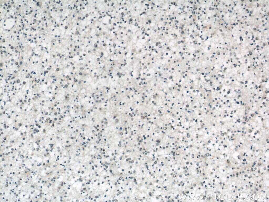 Immunohistochemistry of paraffin-embedded human gliomas using TARDBP Antibody 12892-1-AP (under 10x lens) TARDBP IHC Immunohistochemistry 12892-1-AP TARDBP Antibody ALS10; TDP-43; Tdp43