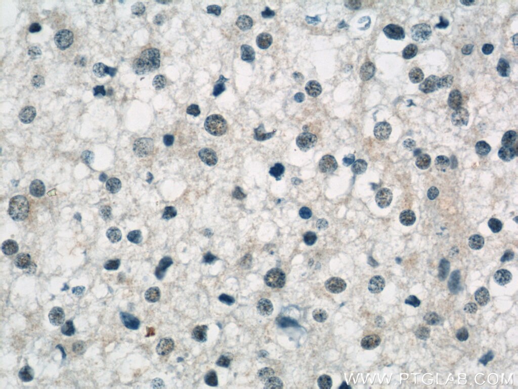 Immunohistochemistry of paraffin-embedded human gliomas using TARDBP Antibody 12892-1-AP (under 40x lens) TARDBP IHC Immunohistochemistry 12892-1-AP TARDBP Antibody ALS10; TDP-43; Tdp43