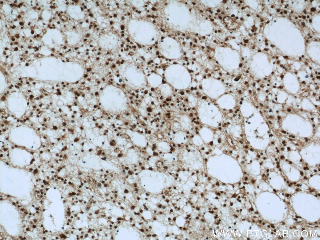 Immunohistochemistry of paraffin-embedded human gliomas using TARDBP Antibody 12892-1-AP (under 10x lens) TARDBP IHC Immunohistochemistry 12892-1-AP TARDBP Antibody ALS10; TDP-43; Tdp43