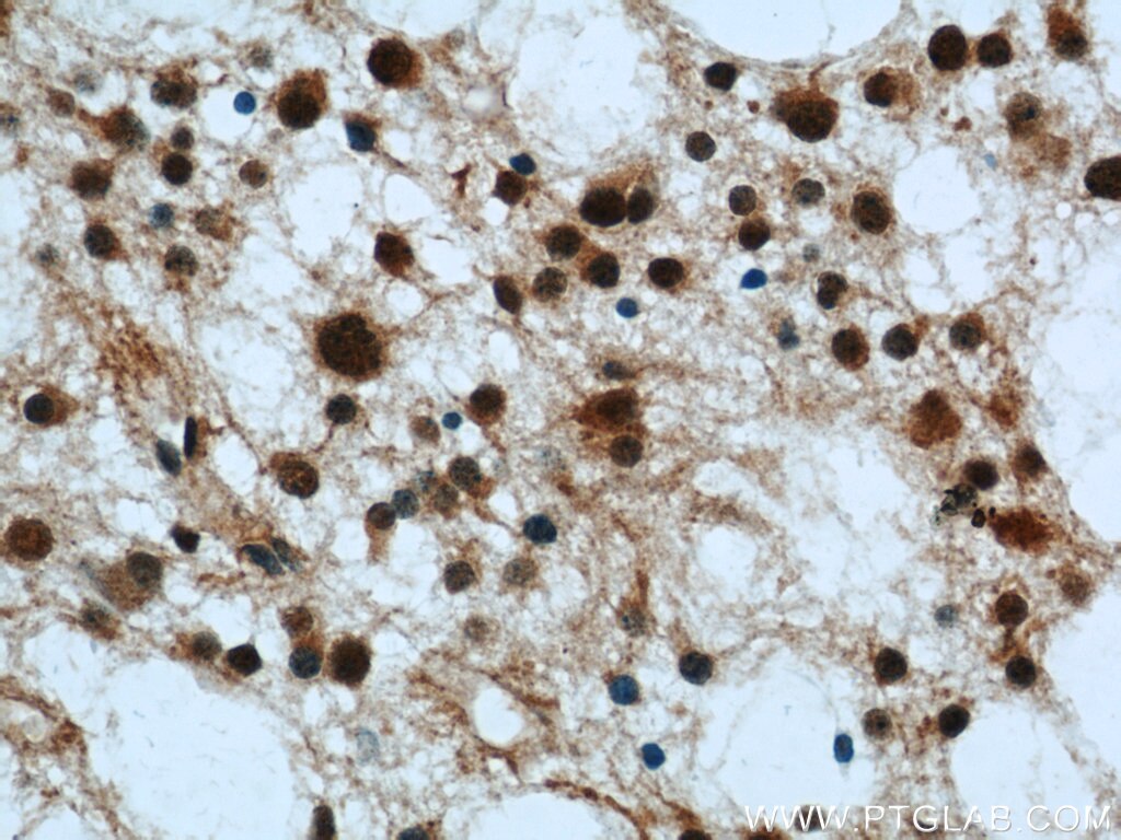Immunohistochemistry of paraffin-embedded human gliomas using TARDBP Antibody 12892-1-AP (under 40x lens) TARDBP IHC Immunohistochemistry 12892-1-AP TARDBP Antibody ALS10; TDP-43; Tdp43