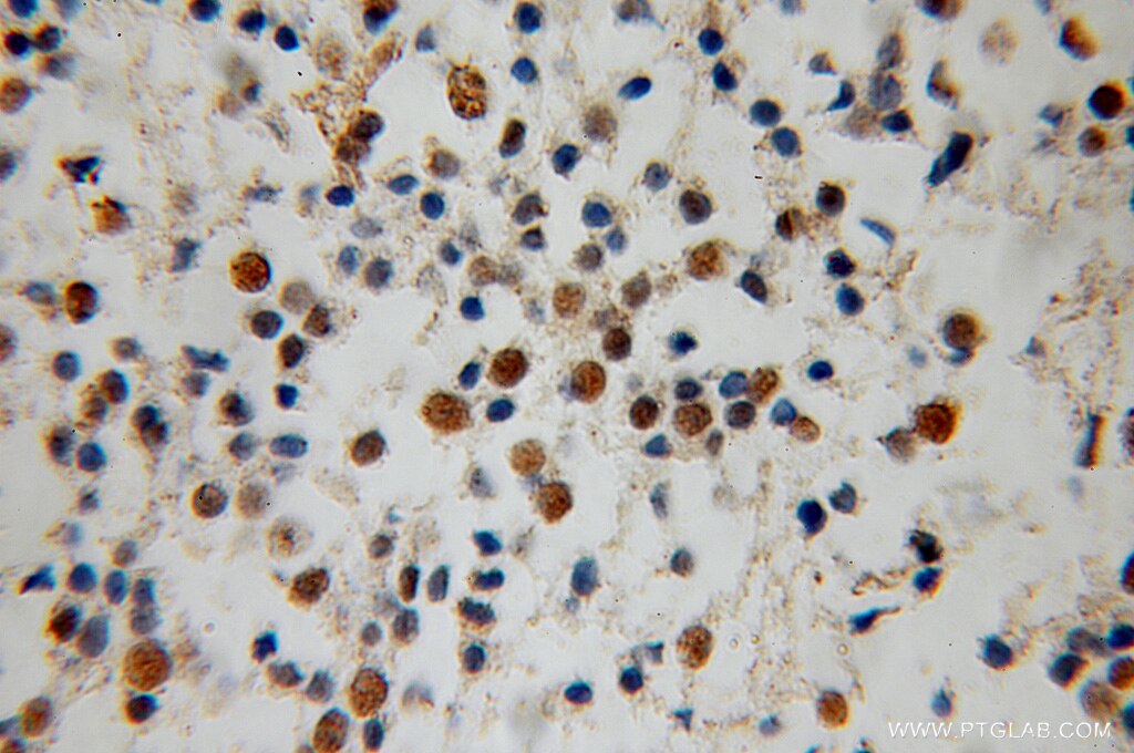 Immunohistochemistry of paraffin-embedded human gliomas using TARDBP Antibody 12892-1-AP (under 25x lens) TARDBP IHC Immunohistochemistry 12892-1-AP TARDBP Antibody ALS10; TDP-43; Tdp43
