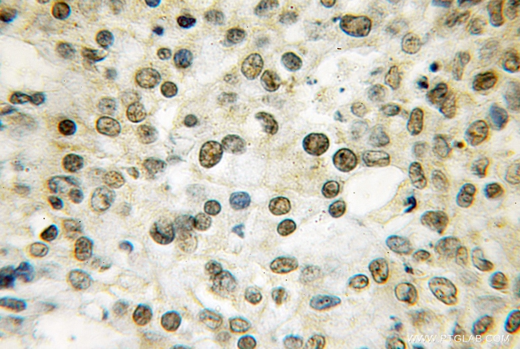 Immunohistochemistry of paraffin-embedded human colon cancer using 12584-1-AP(THAP1 Antibody) at Dilution 1:50 (under 10x lens) THAP1 IHC Immunohistochemical 12584-1-AP THAP1 Antibody FLJ10477; MGC33014