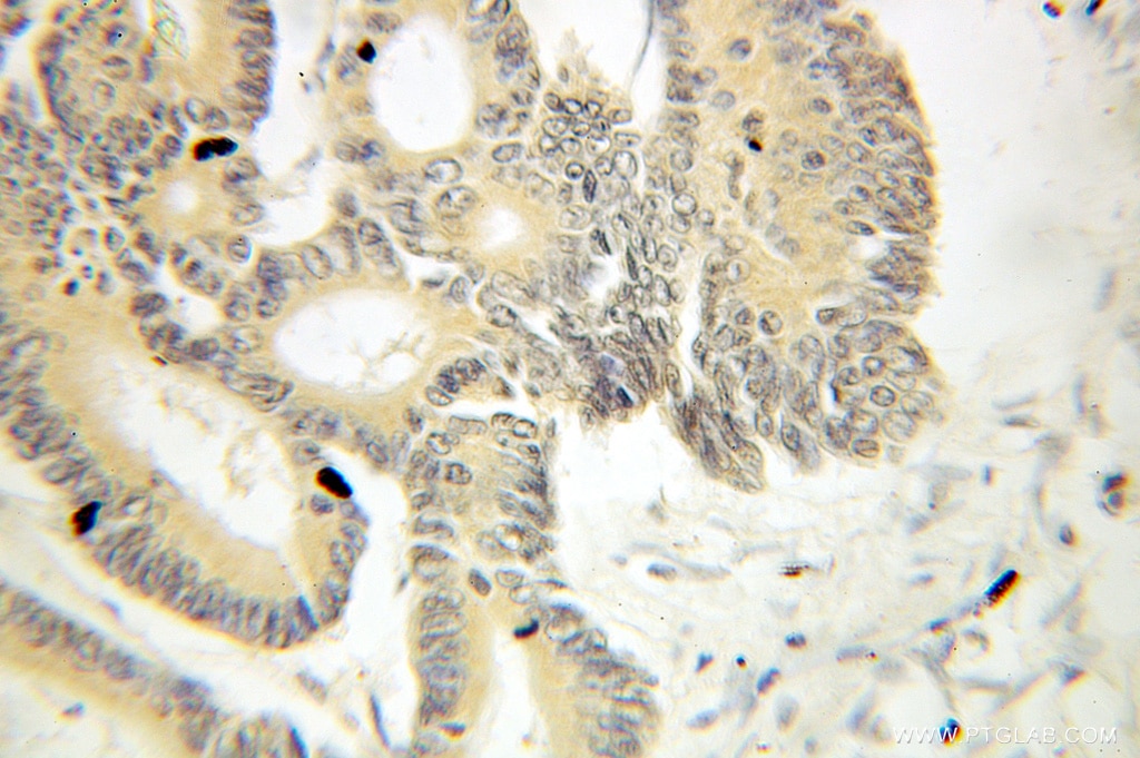 Immunohistochemistry of paraffin-embedded human colon cancer using 10920-1-AP(THOC1 Antibody) at Dilution 1:100 (under 10x lens) THOC1 IHC Immunohistochemical 10920-1-AP THOC1 Antibody HPR1; P84; P84N5