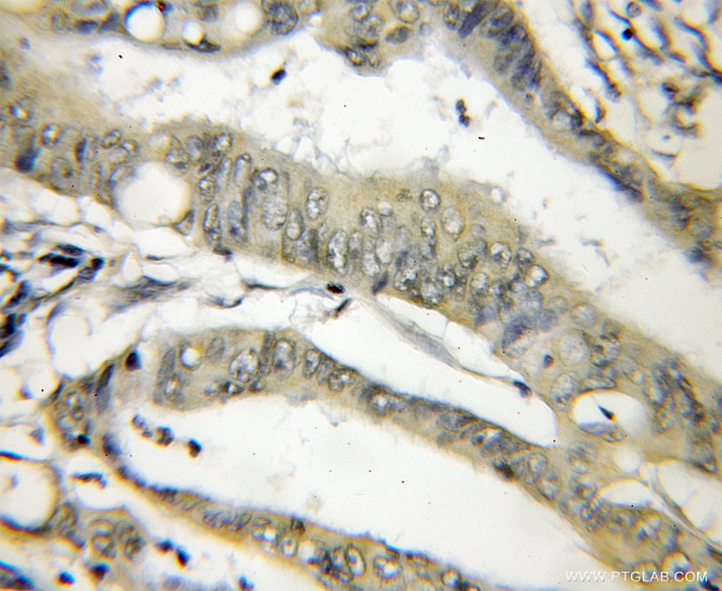 Immunohistochemistry of paraffin-embedded human colon cancer using 11738-1-AP(THOP1 Antibody) at Dilution 1:50 (under 10x lens) THOP1 IHC Immunohistochemical 11738-1-AP THOP1 Antibody EP24.15; MEPD_HUMAN; MP78; TOP