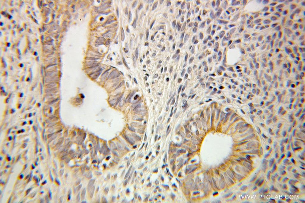 Immunohistochemistry of paraffin-embedded human ovary tumor using 10753-1-AP(TIMP1 Antibody) at Dilution 1:100 (under 10x lens) TIMP1 IHC Immunohistochemical 10753-1-AP TIMP1 Antibody CLGI; EPA; EPO; FLJ90373; HCI; TIMP