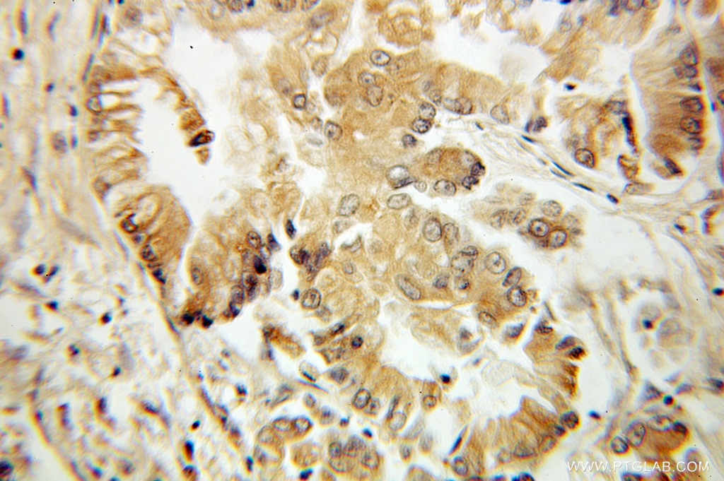Immunohistochemistry of paraffin-embedded human lung cancer using 10500-1-AP(TMS1 Antibody) at Dilution 1:100 (under 10x lens) TMS1 IHC Immunohistochemical 10500-1-AP TMS1 Antibody ASC; CARD5; MGC10332; TMS; TMS-1; TMS1