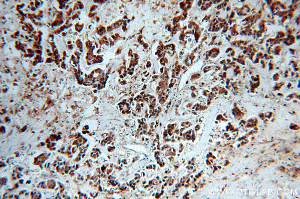 TPD52L2 IHC Immunohistochemical 11795-1-AP TPD52L2 Antibody D54; DKFZp686A1765; hD54