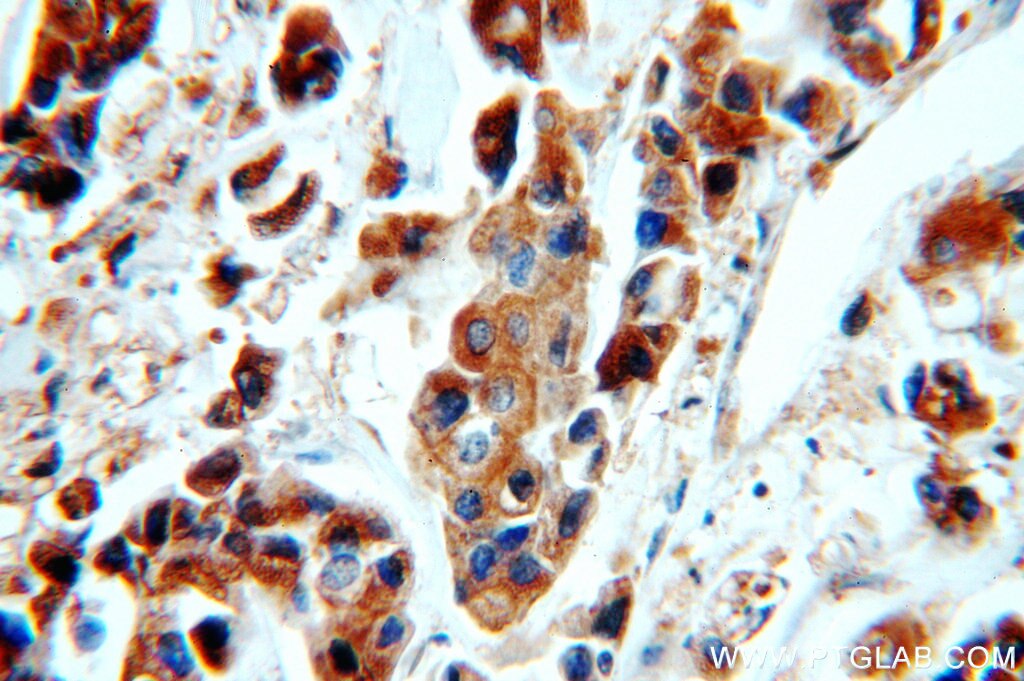 TPD52L2 IHC Immunohistochemical 11795-1-AP TPD52L2 Antibody D54; DKFZp686A1765; hD54