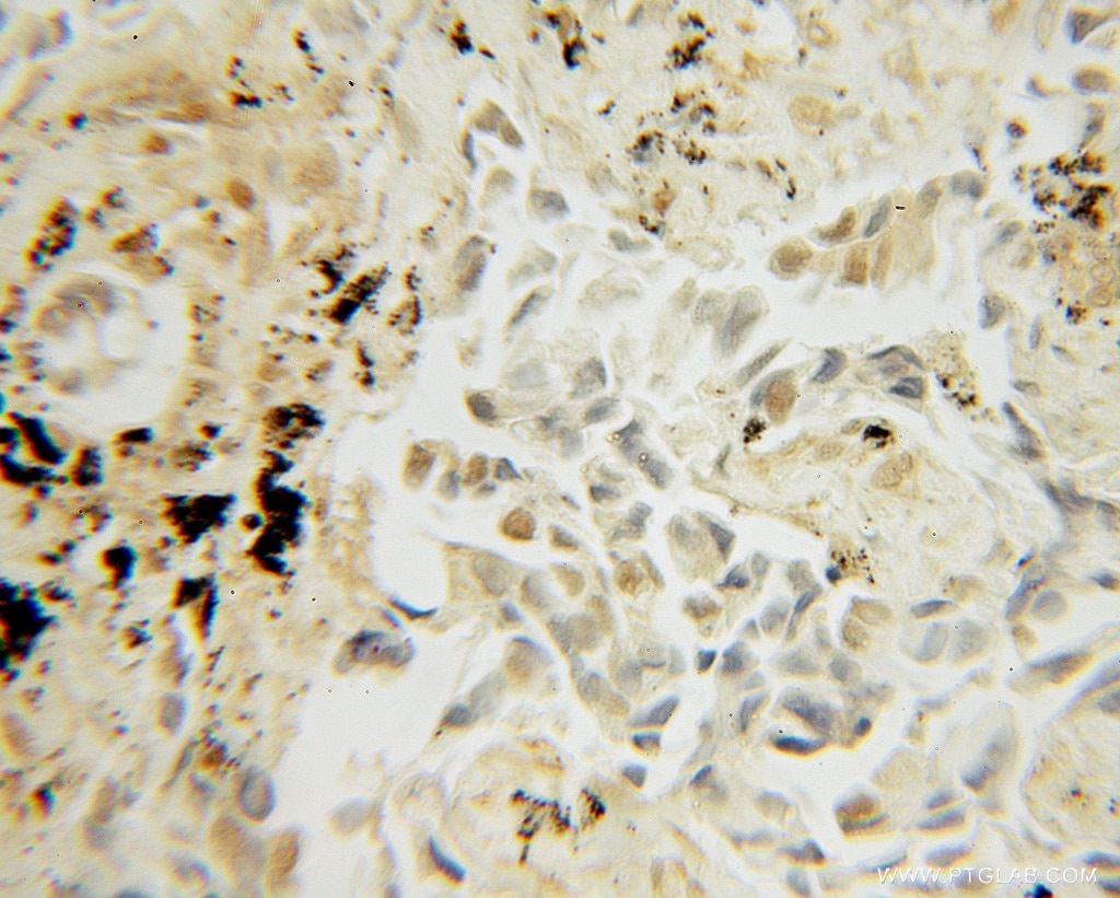 Immunohistochemistry of paraffin-embedded human lung cancer using 10070-1-AP(UBC9 Antibody) at Dilution 1:50 (under 10x lens) UBC9 IHC Immunohistochemical 10070-1-AP UBC9 Antibody C358B7.1; P18; UBC9