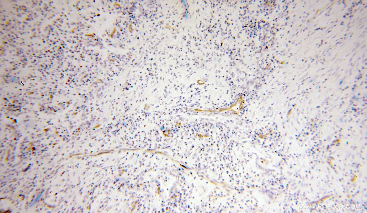VIM IHC Immunohistochemical 10366-1-AP VIM Antibody FLJ36605
