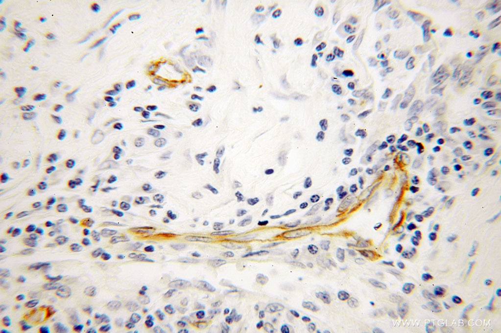 VIM IHC Immunohistochemical 10366-1-AP VIM Antibody FLJ36605