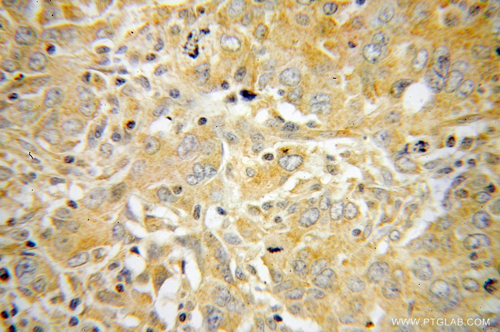 p70(S6K) IHC Immunohistochemical 14485-1-AP p70(S6K) Antibody PS6K; S6K; S6K1; STK14A; p70(S6K)-alpha; p70-S6K; p70-alpha