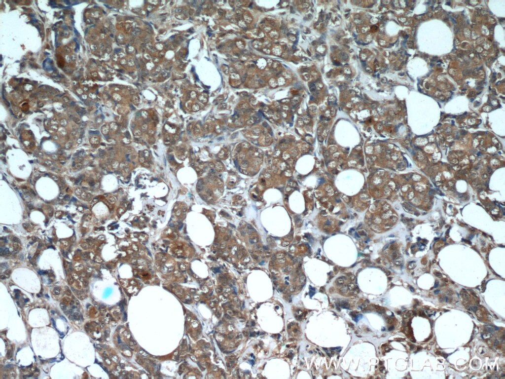 Phospho-Akt (Tyr315) IHC Immunohistochemical 60072-1-Ig Phospho-Akt (Tyr315) Antibody AKT; MGC99656; PKB; PKB-ALPHA; PRKBA; RAC; RAC-ALPHA