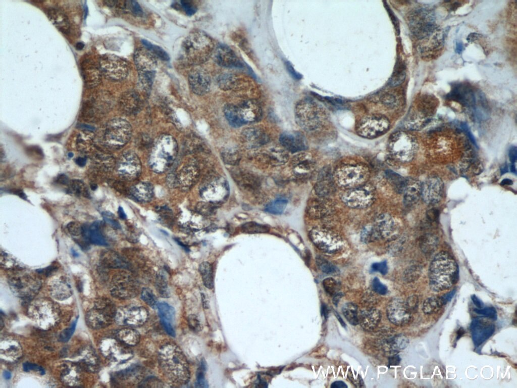 Phospho-Akt (Tyr315) IHC Immunohistochemical 60072-1-Ig Phospho-Akt (Tyr315) Antibody AKT; MGC99656; PKB; PKB-ALPHA; PRKBA; RAC; RAC-ALPHA